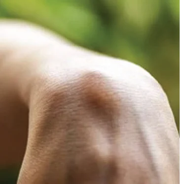 Survival and Treatment Options for People Suffering from Sarcoma
